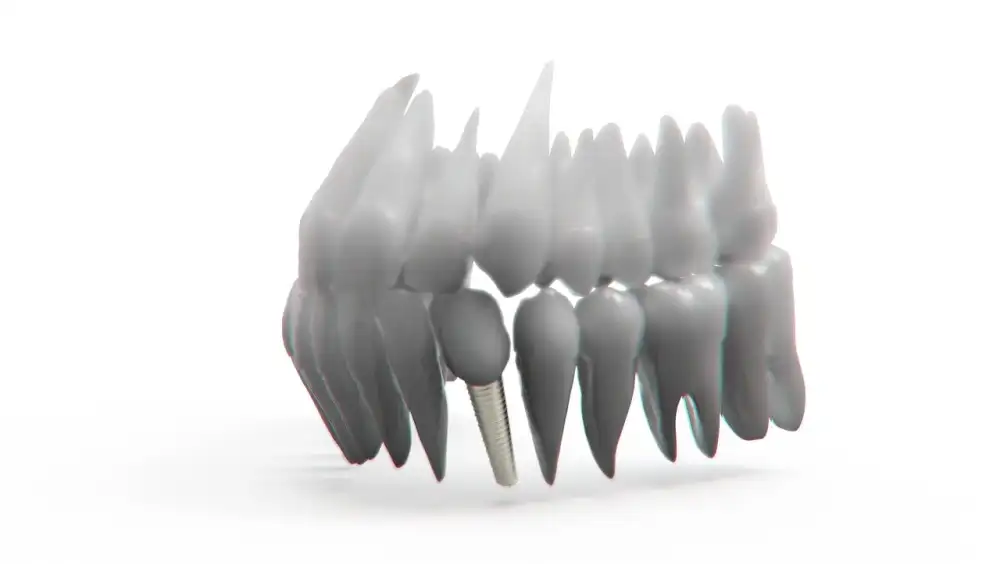 Kolik Stojí Zubní Implantát