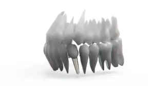 Kolik Stojí Zubní Implantát
